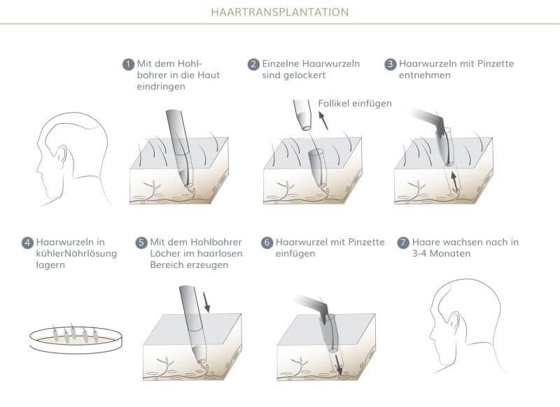 Graphik zum Ablauf einer Haartransplantation - Haarzentrum in München 