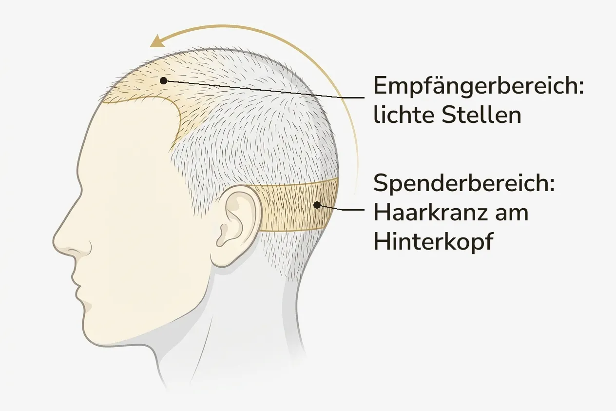 Schema: Haarwurzeln werden aus dem Spenderbereich am Hinterkopf in den Empfängerbereich mit lichten Stellen versetzt.