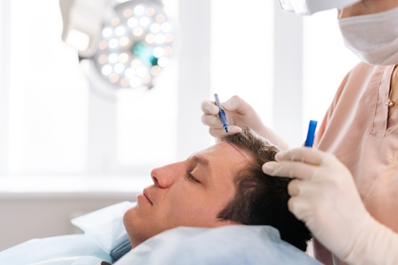 Haartransplantation im Sommer - AEZ Hair, Haarzentrum in München
