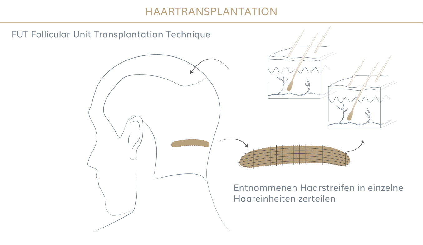 Graphik zur FUT Methode der Haartransplantation - Graphik zum Ablauf einer Haartransplantation - Haarzentrum in München 